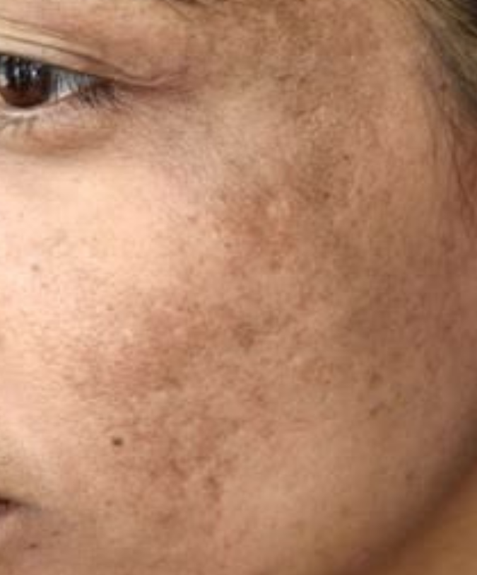 Dark spots