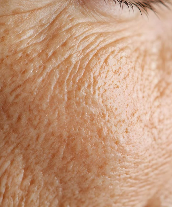 Aging & Wrinkles