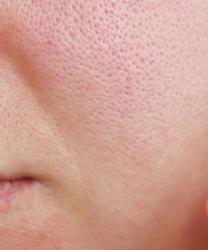 Open pores