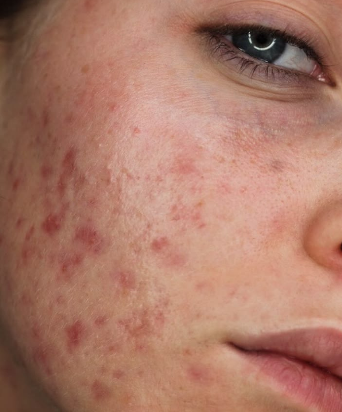 Acne